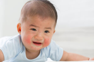 alergia em bebes